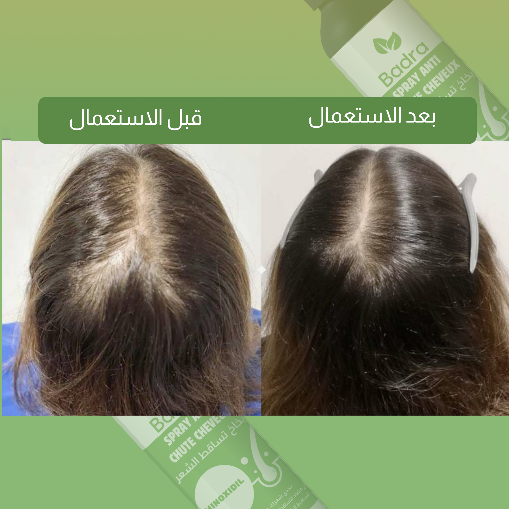 رشاش  تساقط الشعر