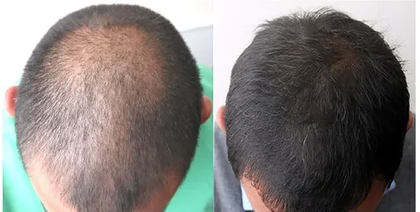 minoxidil couper 5%