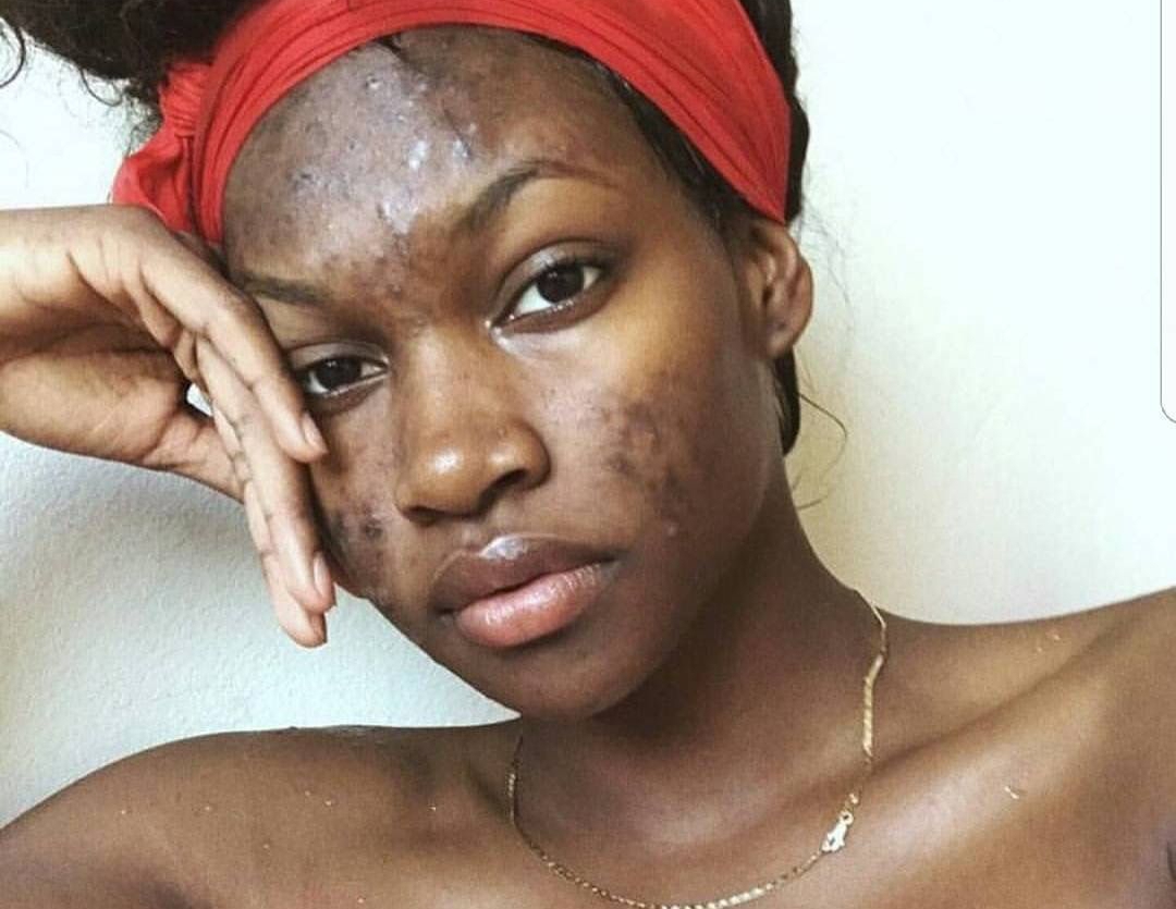 Femme préoccupée par l'état de sa peau