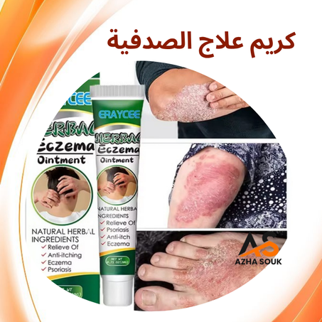 Herbal Ointment For Eczema-  كريم علاج الصدفية والتهيج الجلدي الفعّال