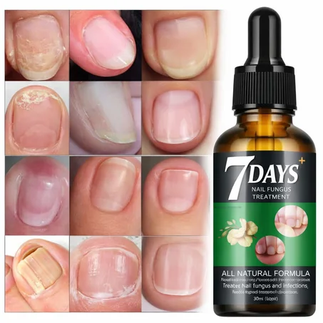 7 Days Nail Fungus Treatment