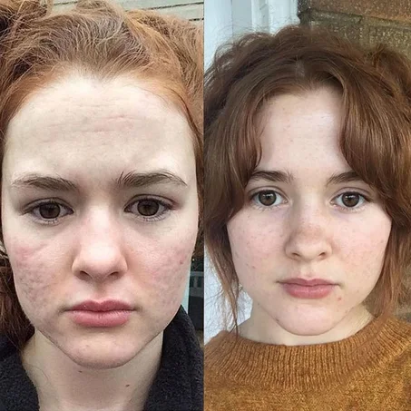 Magic scar removal cream