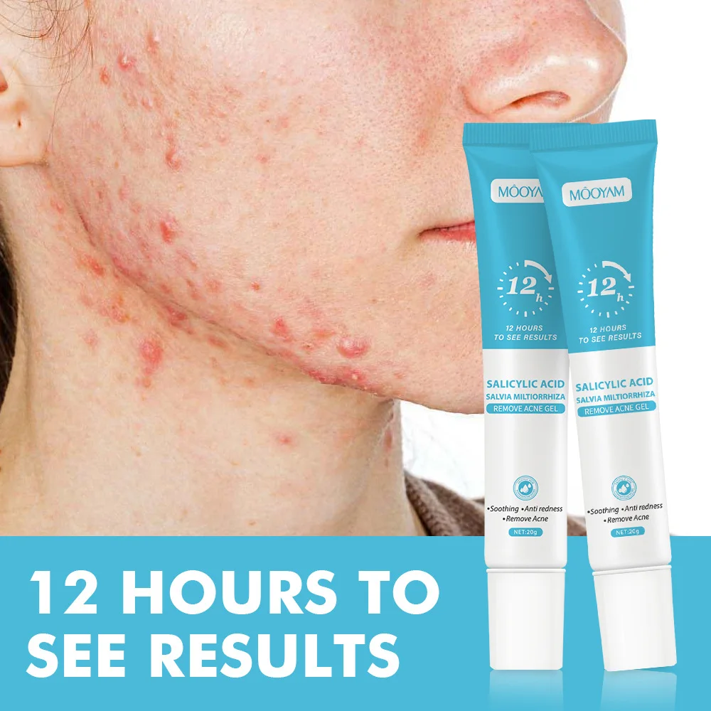 Gel Anti-Acné à l’Acide Salicylique