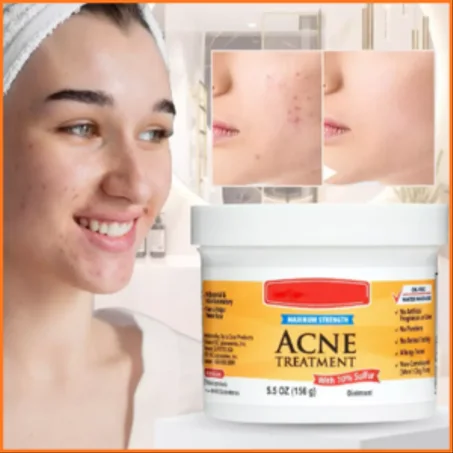 علاج لحب الشباب (Acne Treatment Ointment)