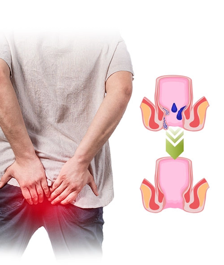 بخاخ البواسير العشبية