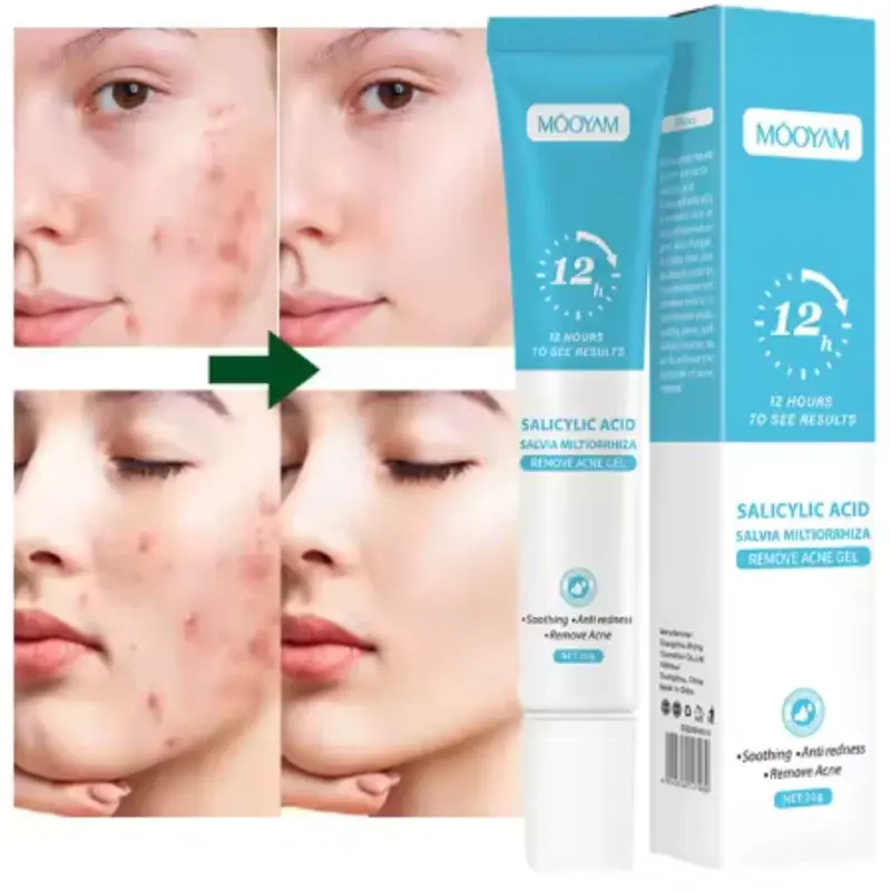 جل MÔOYAM لإزالة حب الشباب والبقع