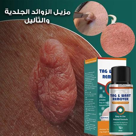 مزيل الزواءد الجلدية