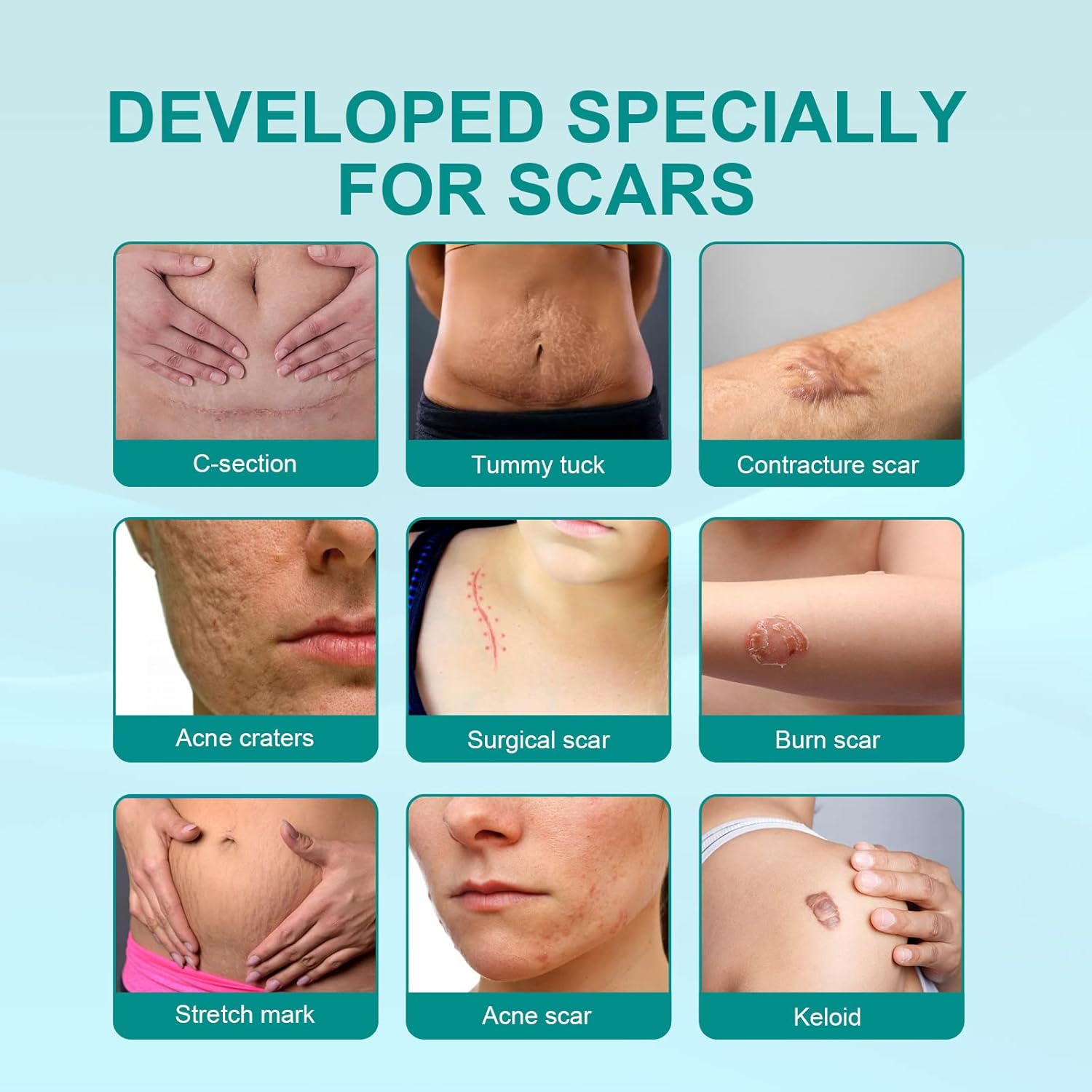 • سبراي طبي لإزالة الندوب