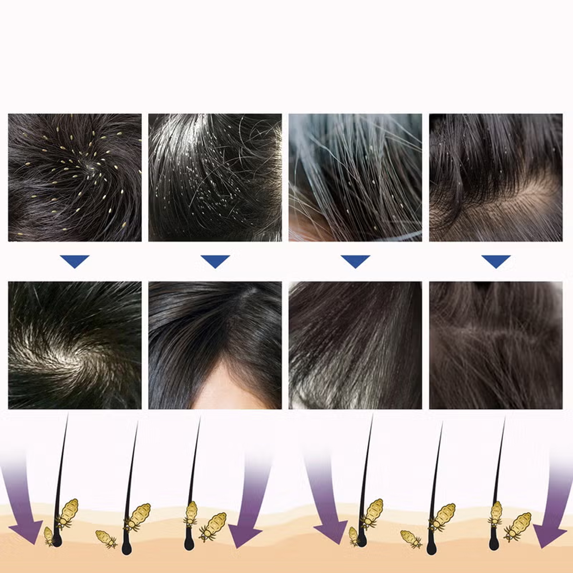 بخاخ علاج فعال للقمل امن للاطفال والكبار