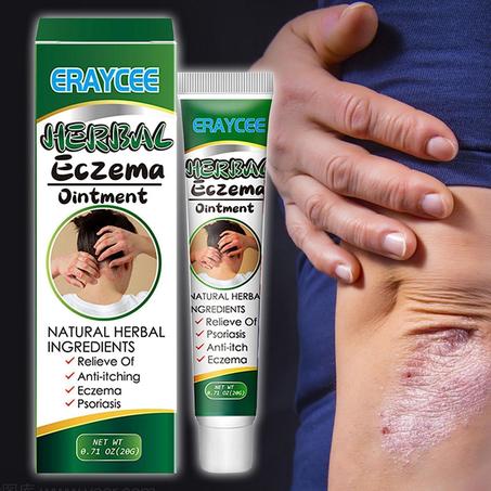 مرهم عشبي للأكزيما - Herbal Ointment For Eczema