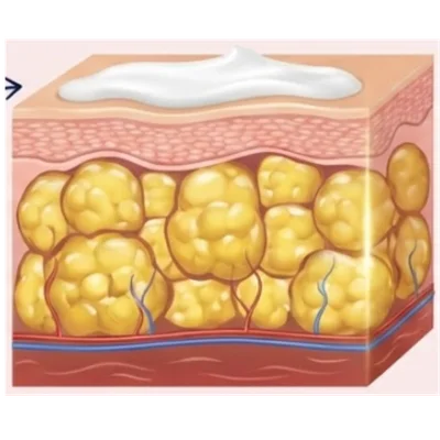 Surface treatment illustration