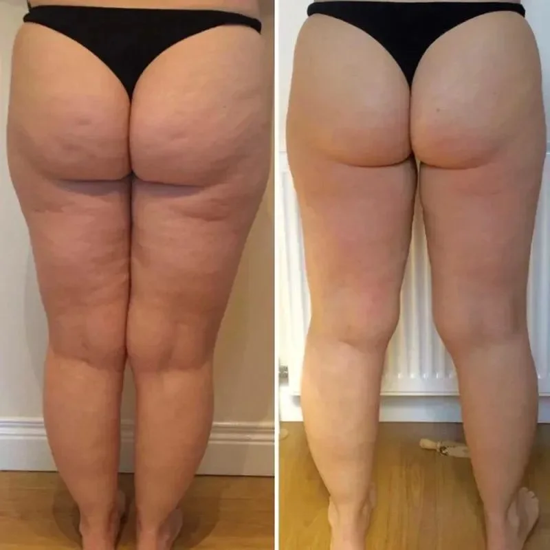 Résultat Cellulite 2