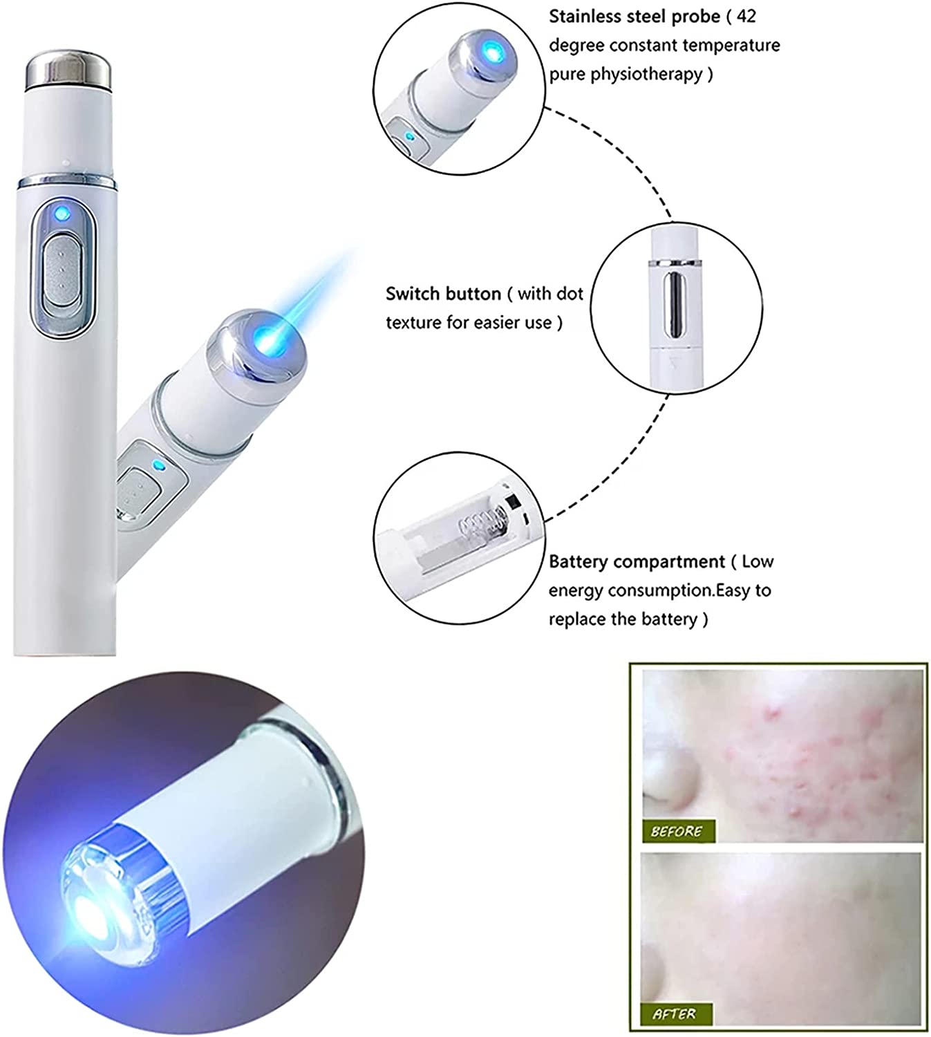 Portable Laser Therapy * قلم الليزر لعلاج الحبوب و الدوالي