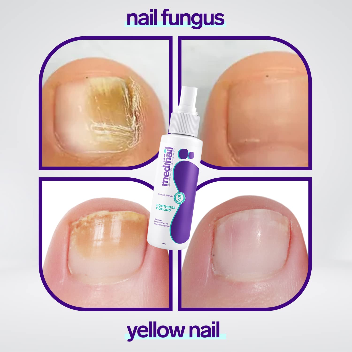 Nail Fungus Spray  * سبراي لعلاج فطريات الأظافر