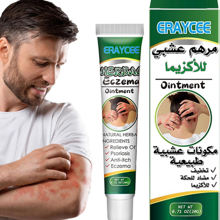 كريم علاج الأكزيما