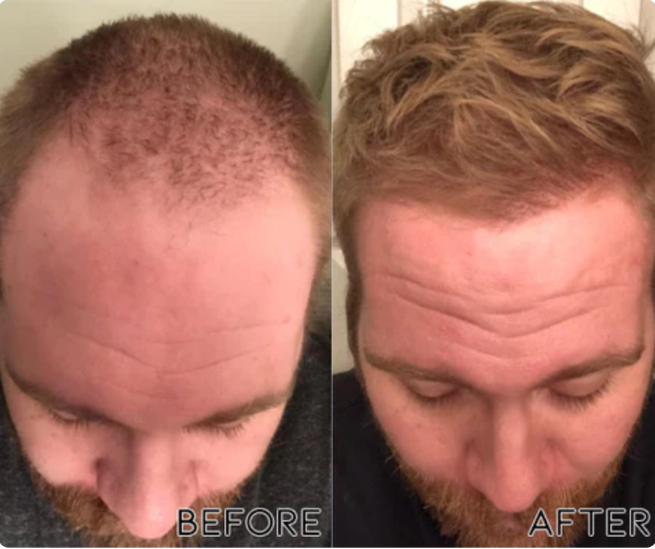 minoxidil %5   بخاخ الشعر مينوكسيديل الأصلي لعلاج مشاكل الصلع