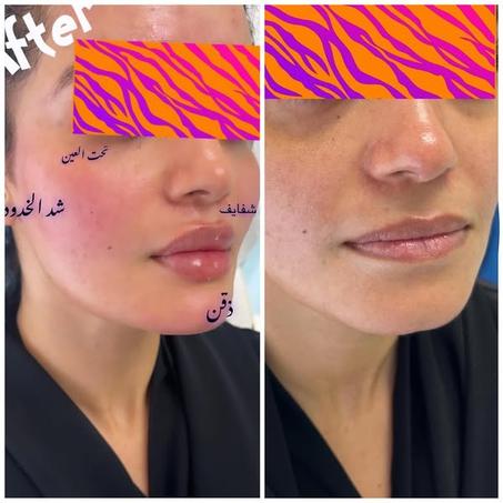 احصلي على شفاه أكثر امتلاءً في 14 يوم فقط مع Deroll!