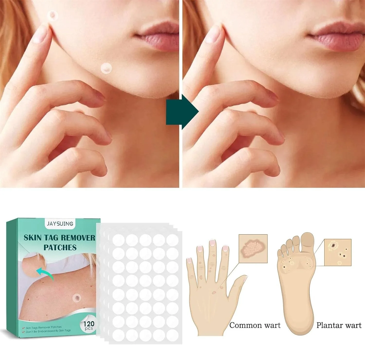 لاصقات لإزالة الزوائد الجلدية