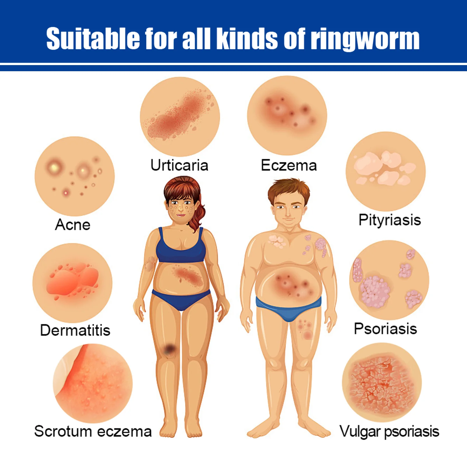 كريم علاج الصدفية والحكة