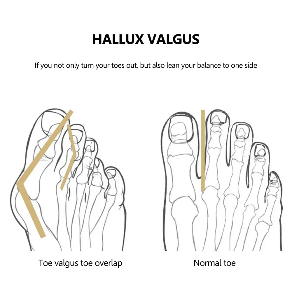 مصحح إصبع القدم الكبير