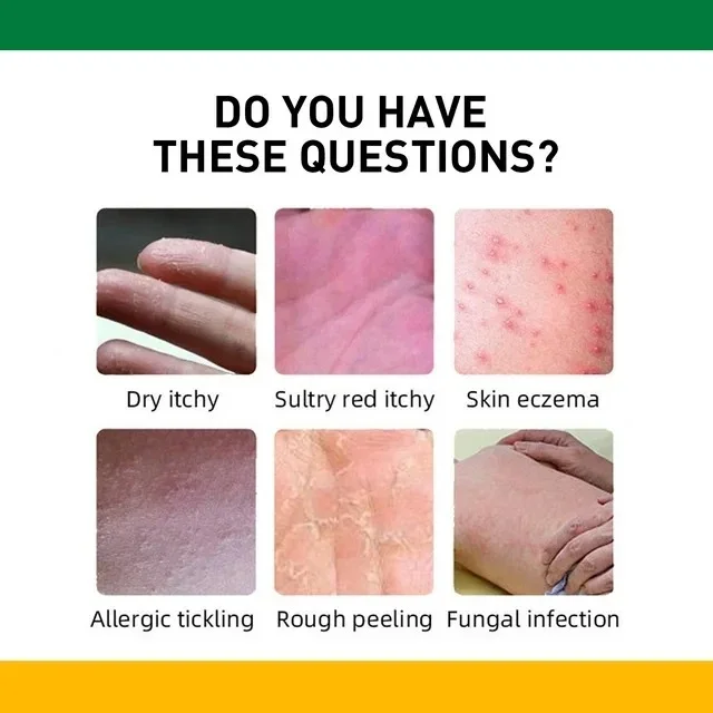 كريم علاج الصدفية والأكزيما والتهاب الجلد