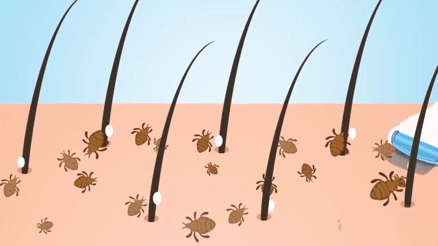 جهاز إزالة القمل والصيبان من الشعر