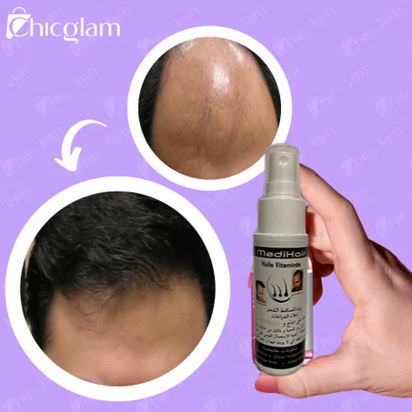 اسبراي تساقط الشعر MediHair