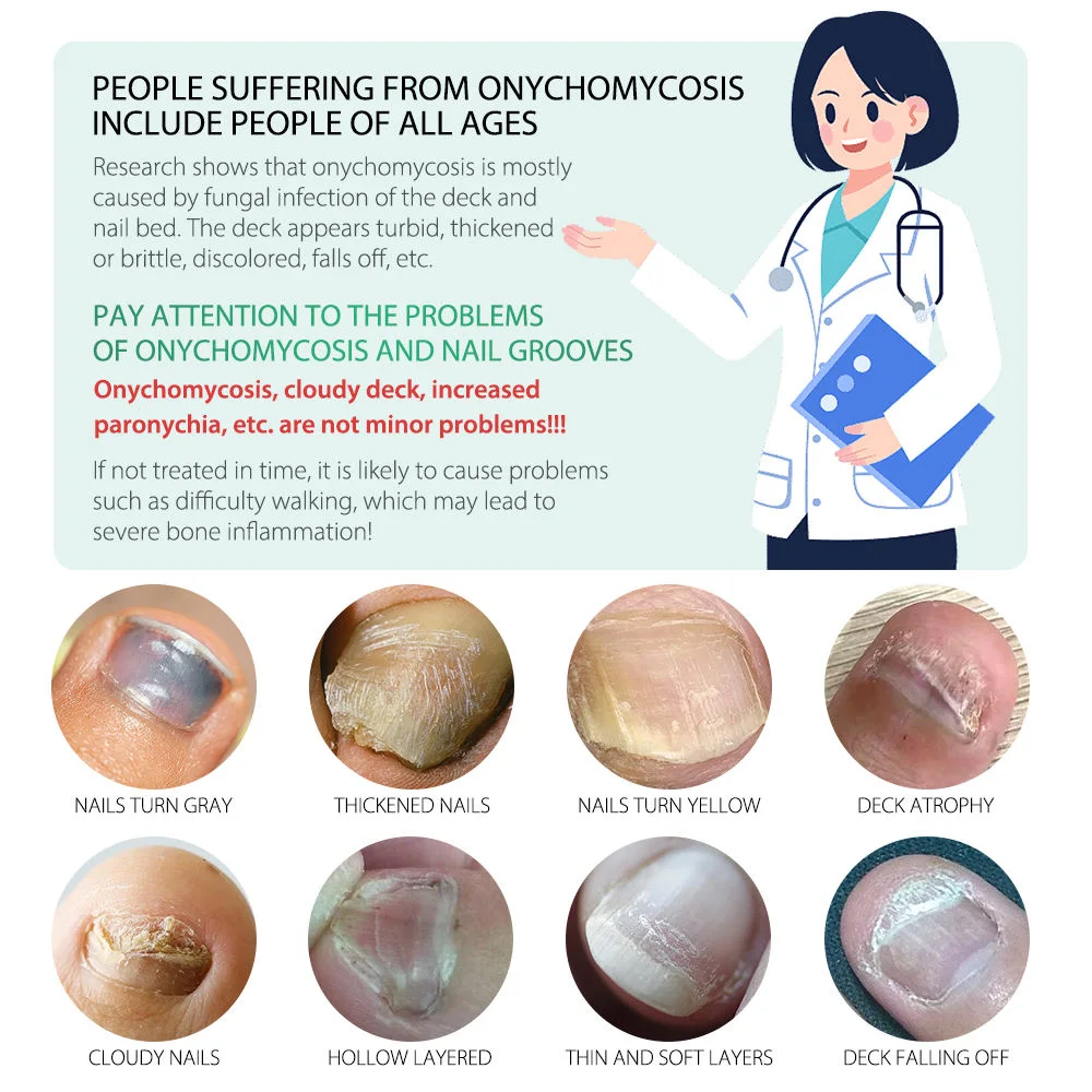 Sérum Anti-Champignons des Ongles – Traitement Intensif 7 Jours