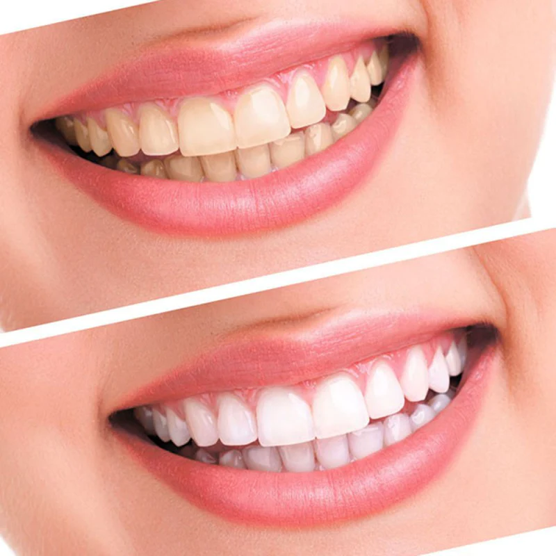 KIT DE BLANCHIMENT DENTAIRE || U-SMILE