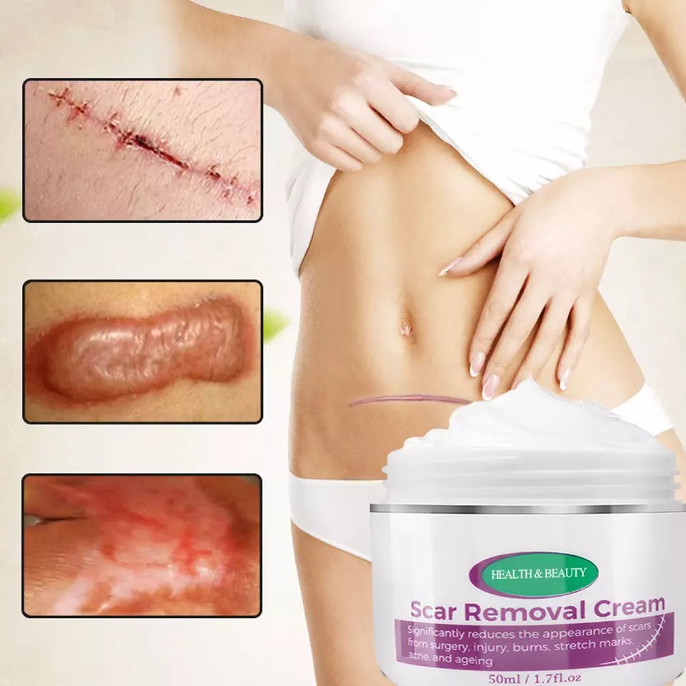 Magic scar removal cream