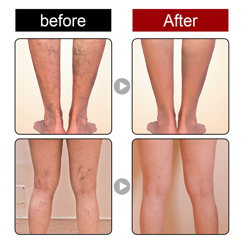 Varicose Veins Relief Cream