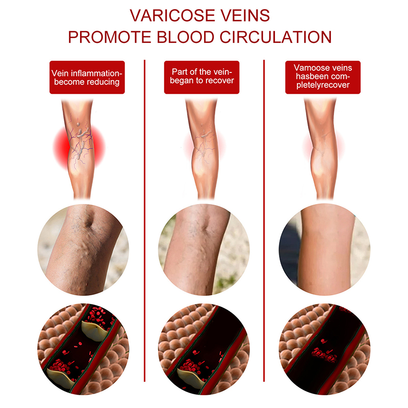 Varicose Veins Relief Cream