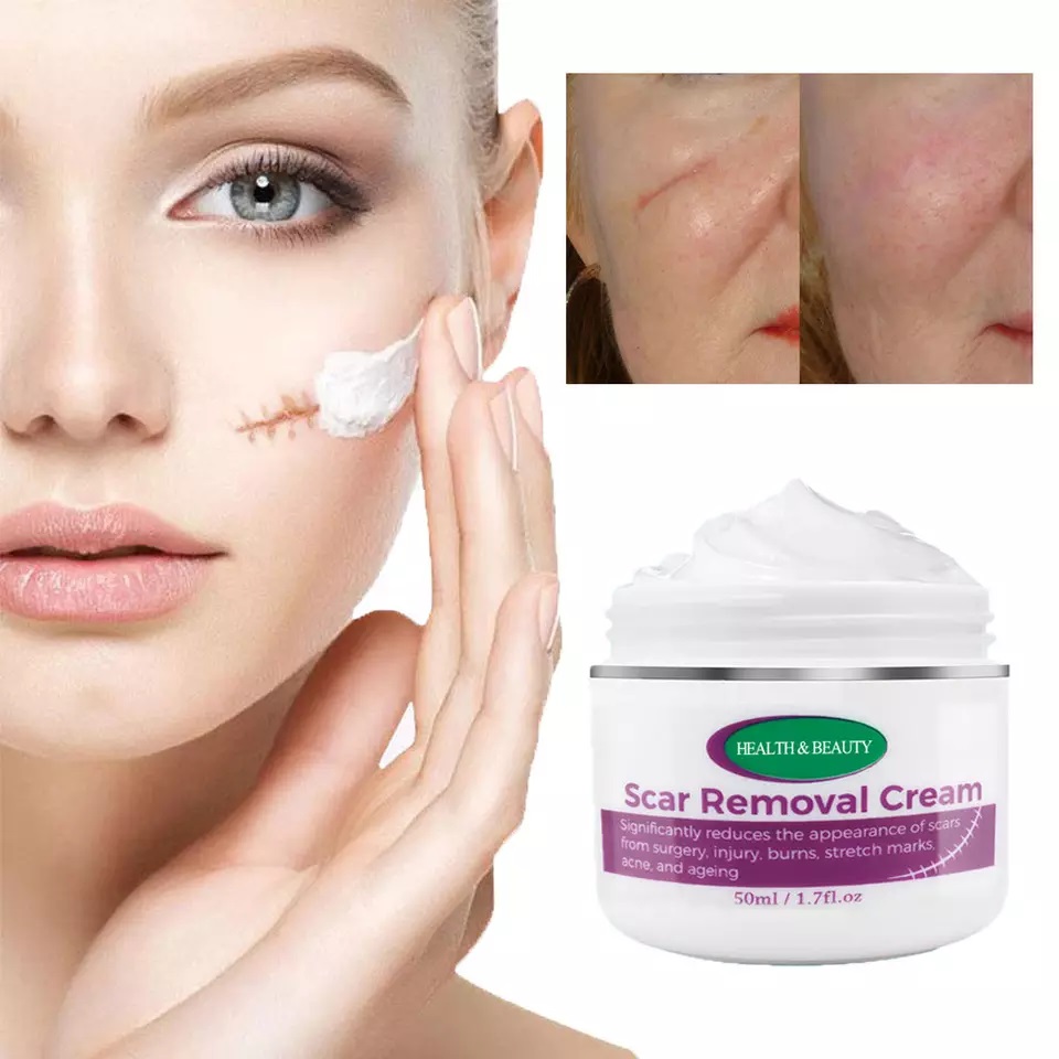 Magic scar removal cream