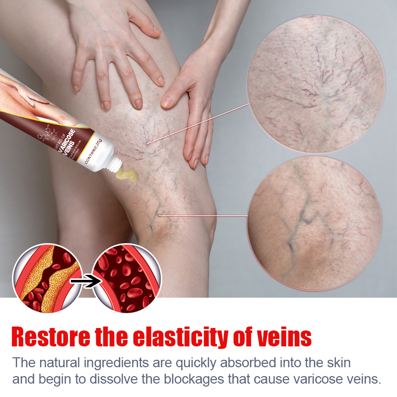 Varicose Veins Relief Cream