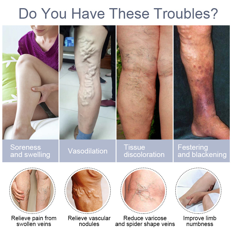 Varicose Veins Relief Cream