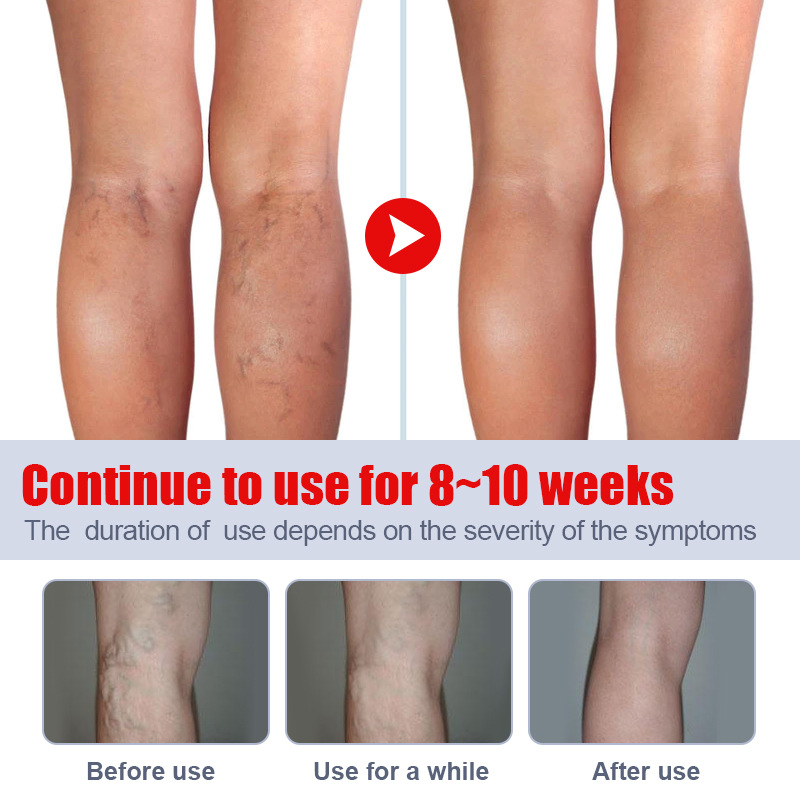 Varicose Veins Relief Cream