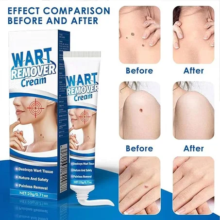 Wart Remover Cream