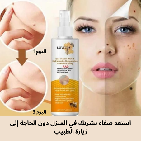 رذاذ إزالة الثآليل