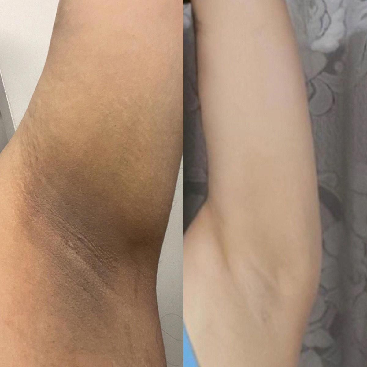 Armpit Whitening Cream