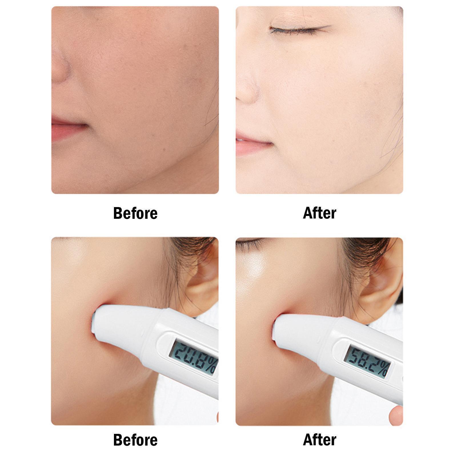 Freckle Remover For Skin Whitening