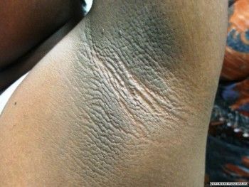 Armpit Whitening Cream