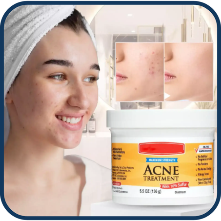 مرهم لعلاج حب الشباب (156غ)