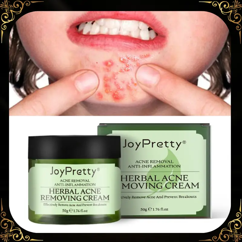 كريم إزالة حب الشباب وآثاره للنساء  - بشرة صافية ونضرة