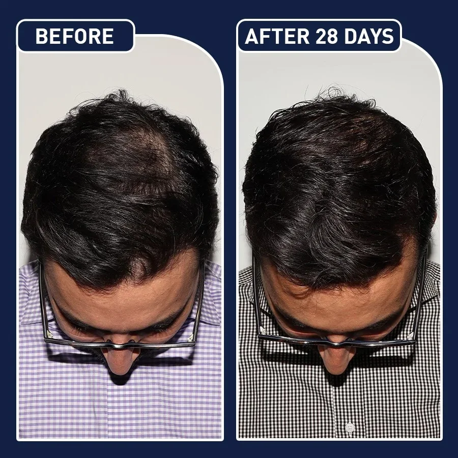 البخاخ الأمريكي لنمو الشعر FEG