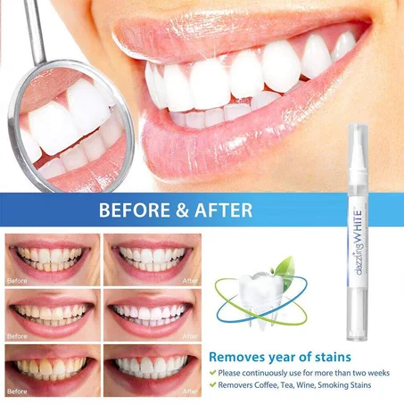 Blanchisseur de Dents Instantané