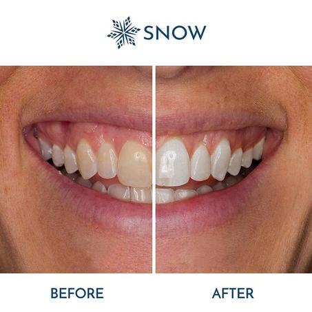 Snow Teeth Whitening جــوهر تــبييض الأسنــان!