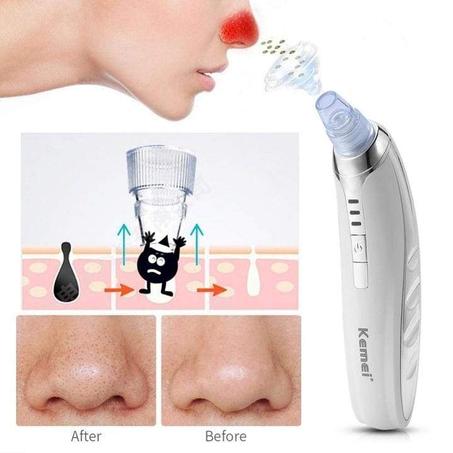 No Blackheads™ Aspirateur de points noirs