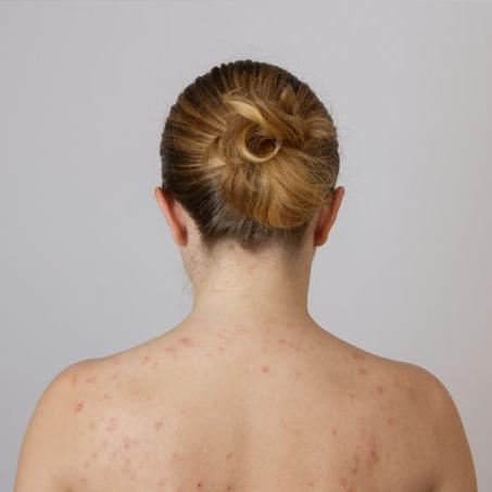 ACNÉ / PEAUX JEUNES